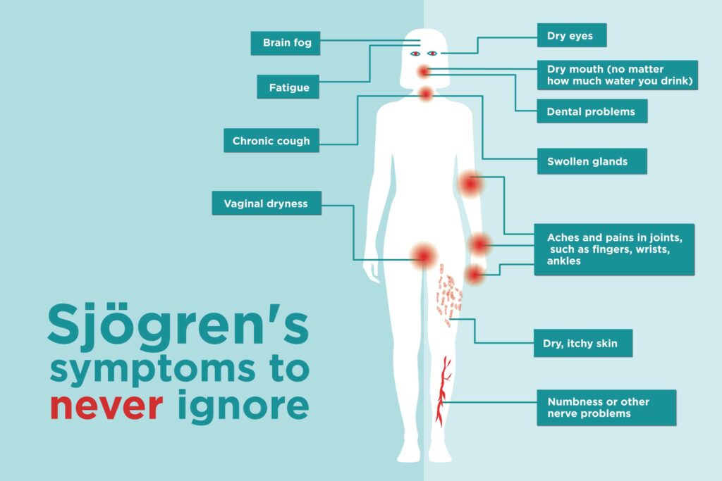 symptoms of Sjögren's syndrome