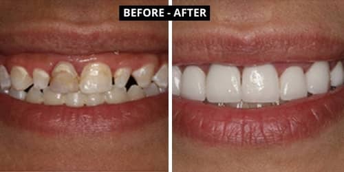 smile makeover