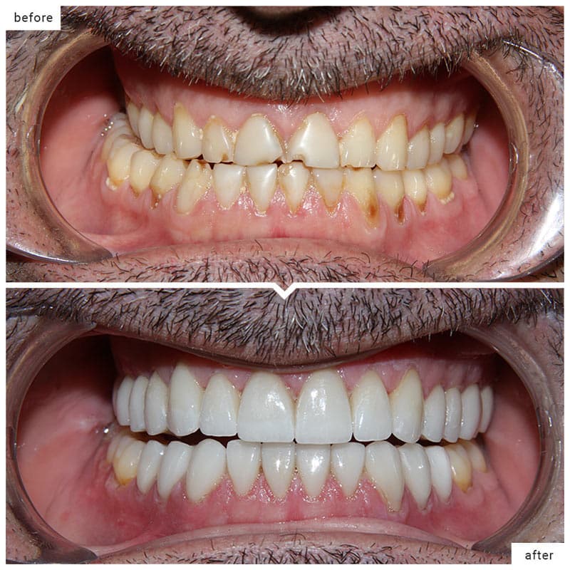 smile makeover before and after