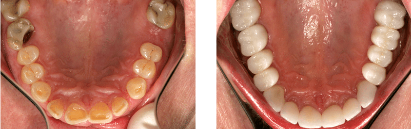 dental bridge before and after