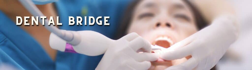 dental bridge