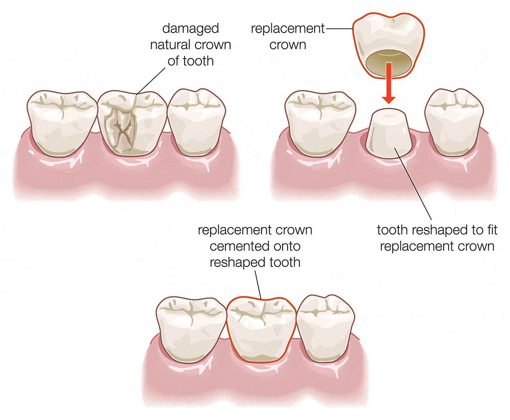 dental crowns procedure