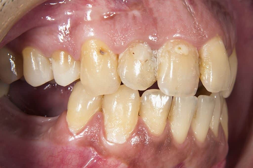 dental plaque look
