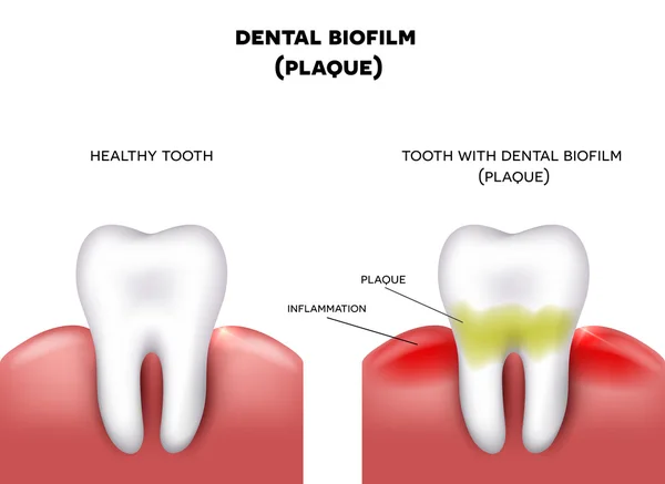 what is dental plaque
