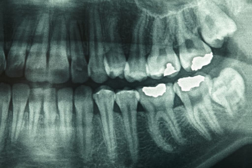 dental xray