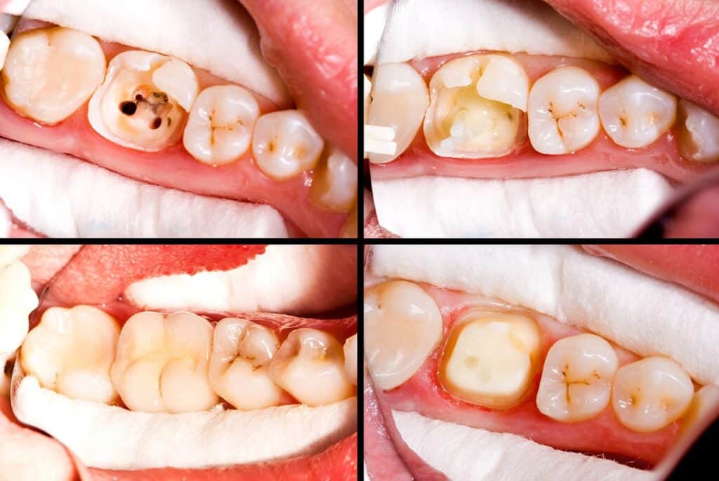 Before and after root canal treatment RCT