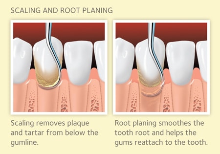 Teeth scaling procedure