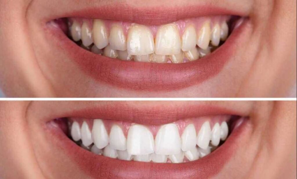 Before(above) and After(below) Teeth whitening