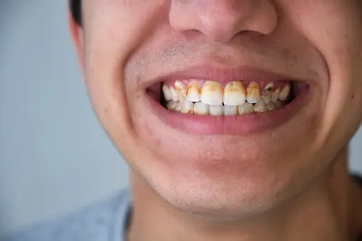 Tartar in Teeth